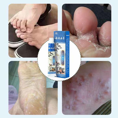 康凈衛(wèi)生用品 專業(yè)止癢噴劑廠家在線咨詢，您的個(gè)人衛(wèi)生守護(hù)者